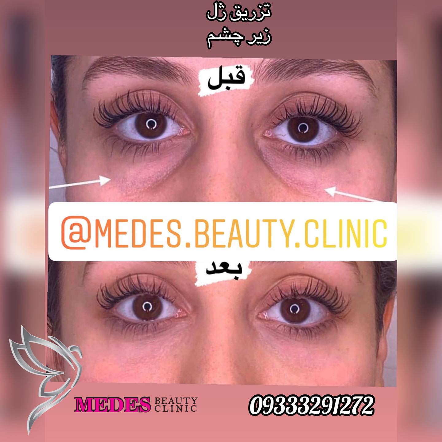 گالری فیلر زیر چشم